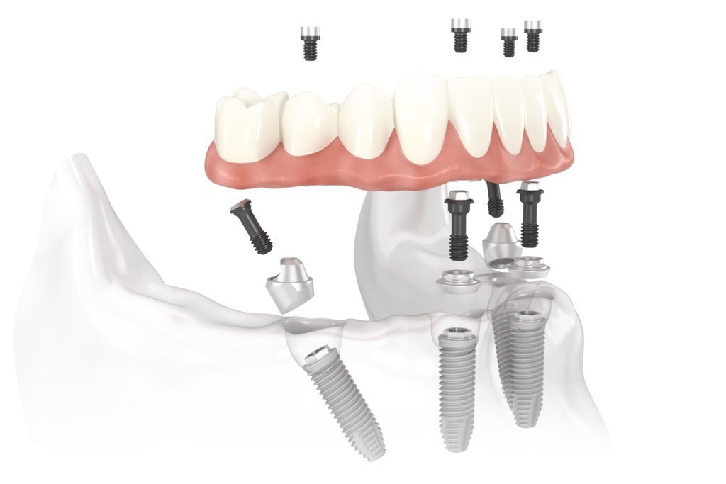 All on 4 Dental Implants Nobel_Biocare_All-on-4_solution