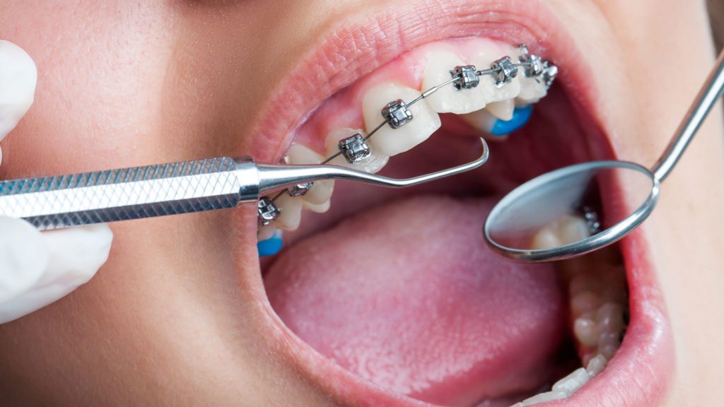 Orthodontics dental bridge