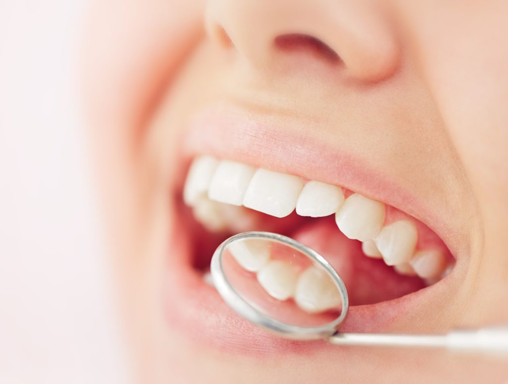All on 4 Dental Implants All on 4 Dental Implants