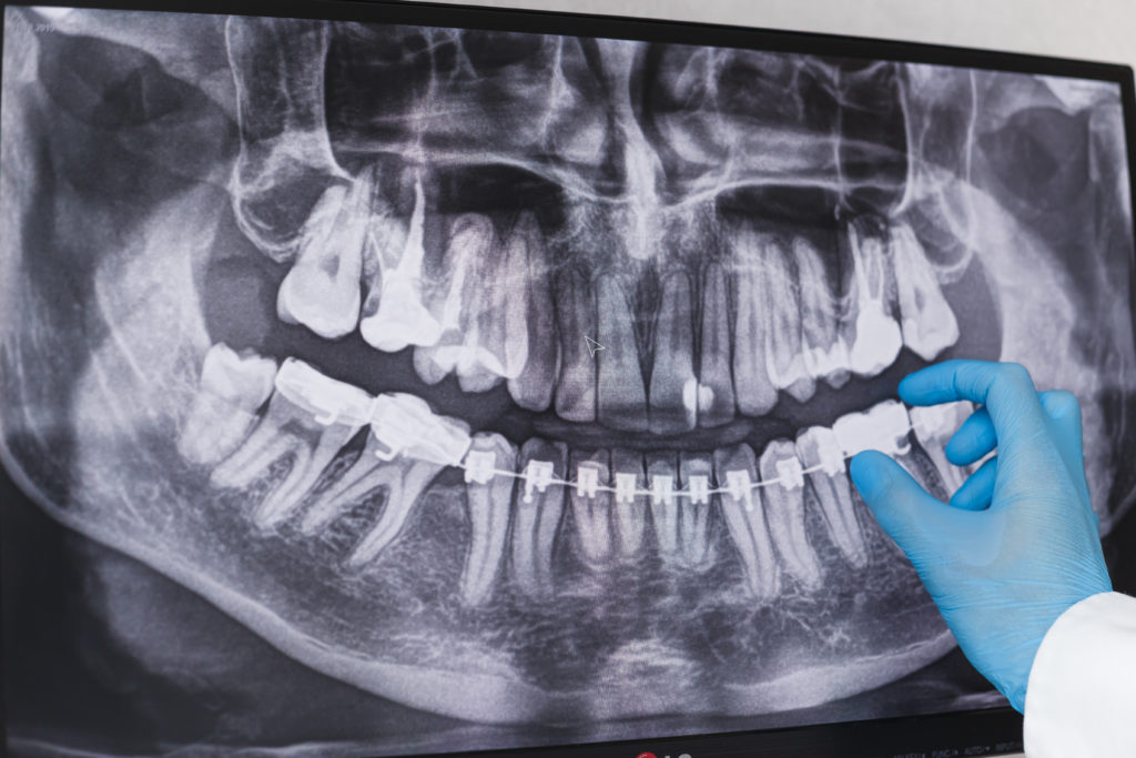 Muelas del Juicio wisdom teeth