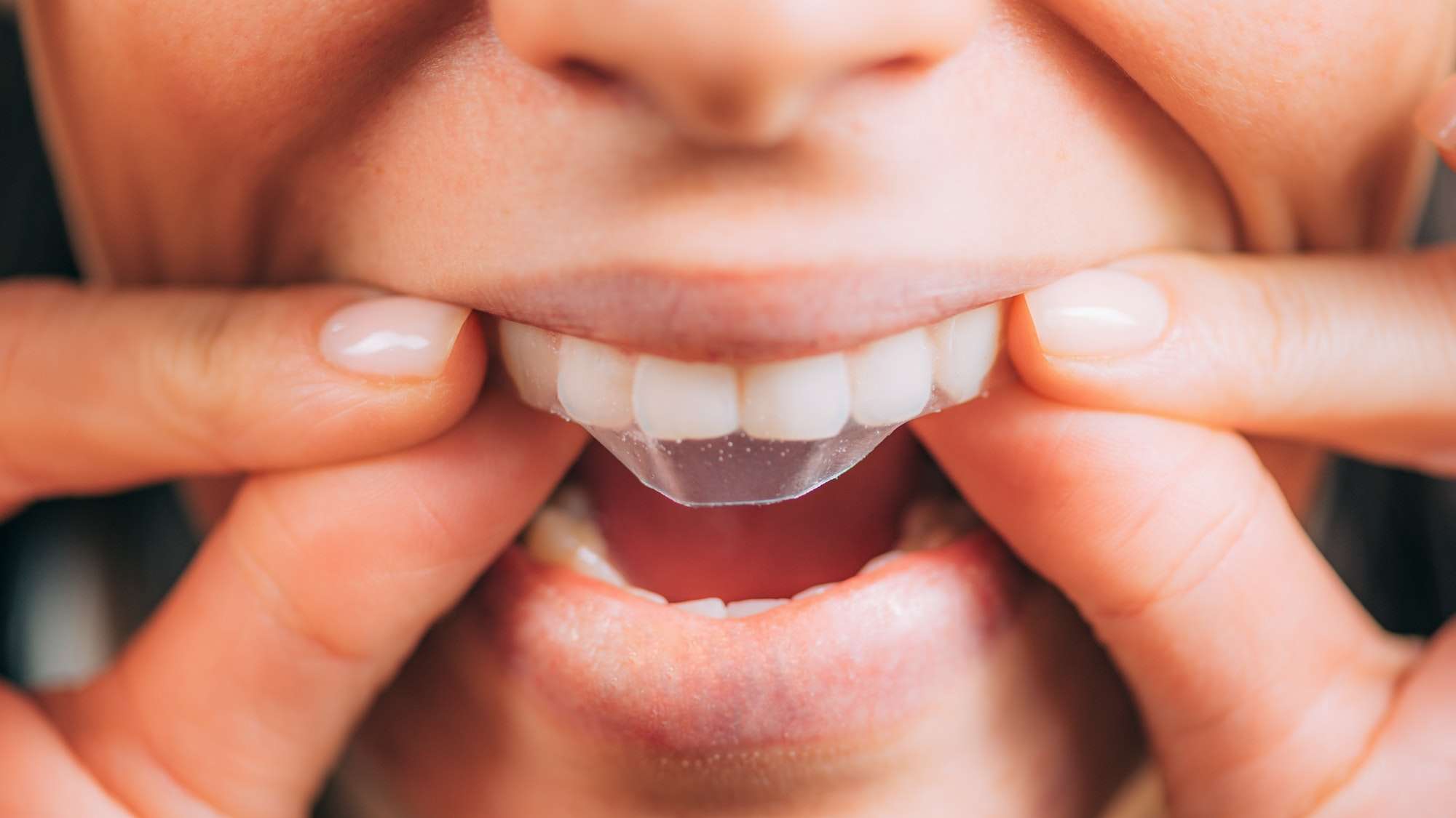 Blanqueamiento teeth whitening strips or white strips