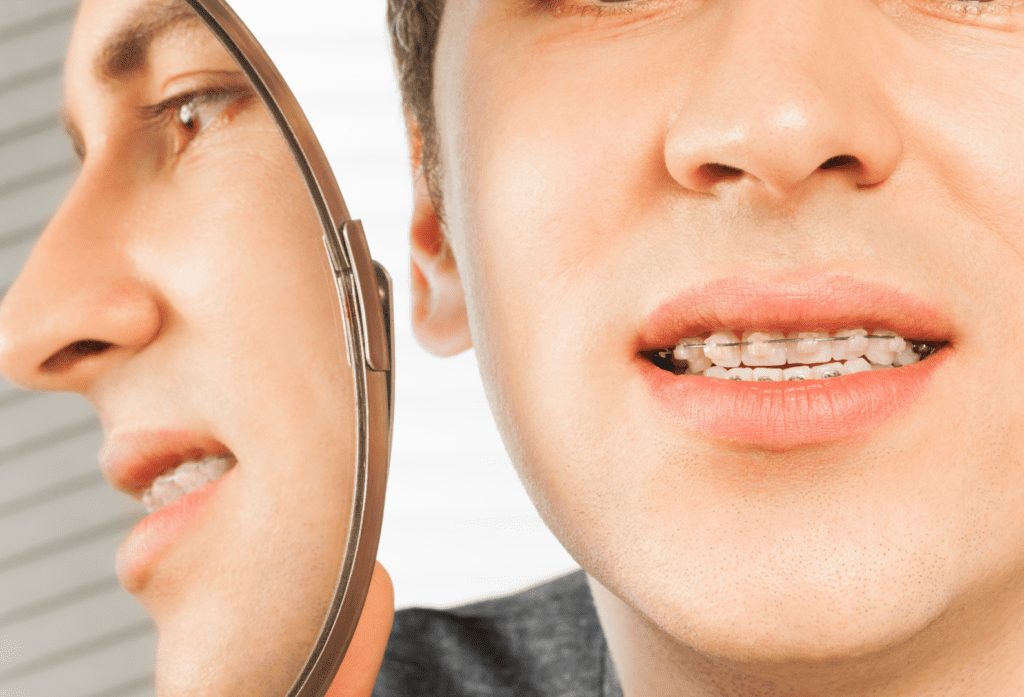 Clear Braces Clear Braces - Brackets Transparentes