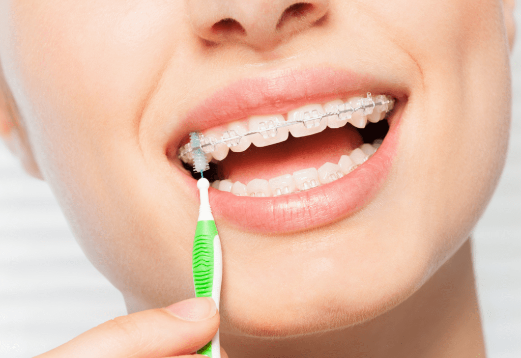Clear Braces Clear Braces - Brackets Transparentes