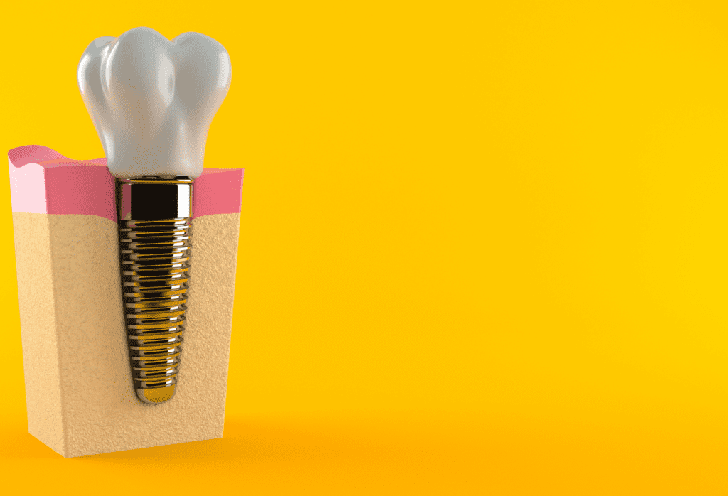 Dentures - Dentadura Postiza