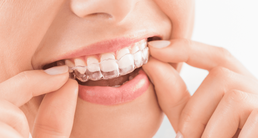 Alineadores Invisalign Aligners - Alineadores Invisalign
