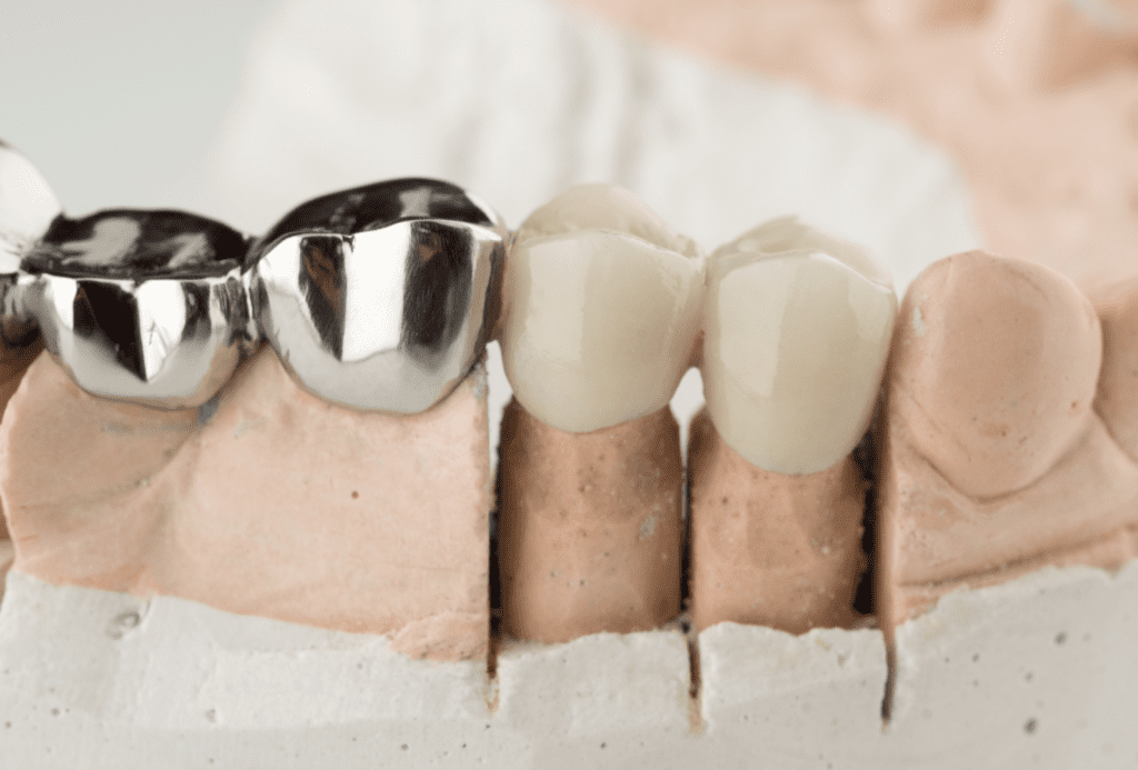 Coronas de Porcelana Porcelain Crowns - Coronas de Porcelana