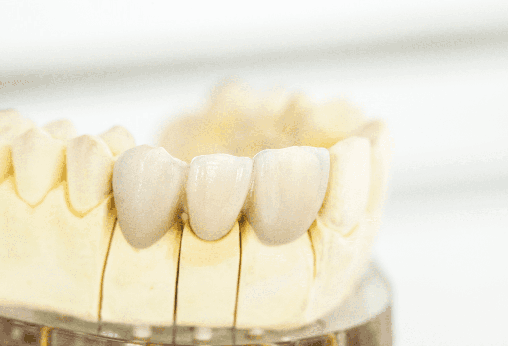 Coronas de Porcelana Porcelain Crowns - Coronas de Porcelana