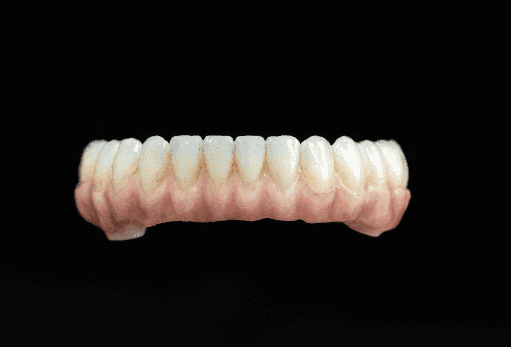 Coronas de Porcelana Porcelain Crowns - Coronas de Porcelana