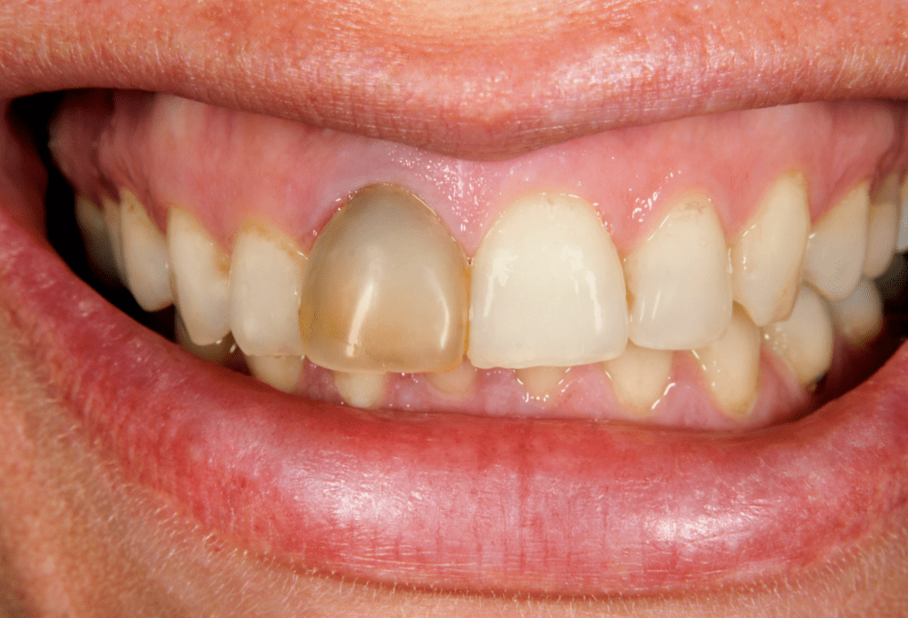 Endodoncia Root Canal