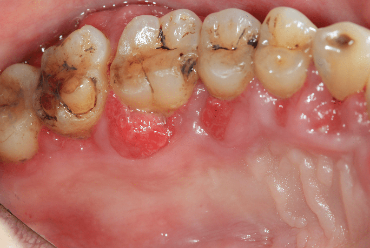 Root Canal Treatment Channel Island Family Dental Ventura