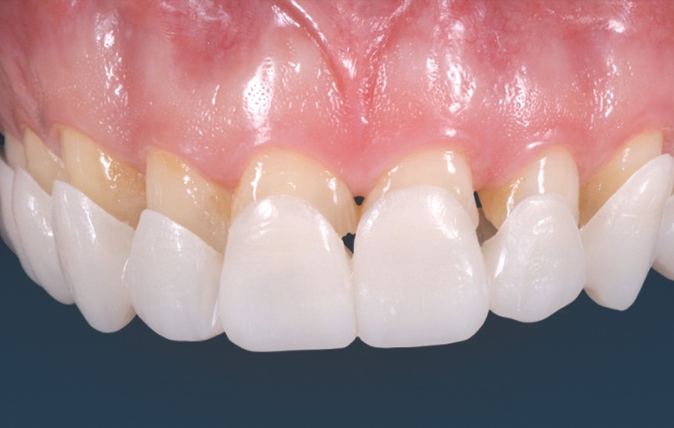 Snap on Smile - Sonrisa a Presión