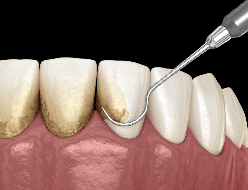 Teeth Cleaning - Limpieza Dental