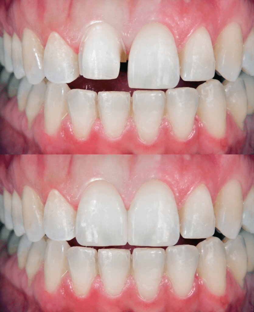 Veneers - Carillas