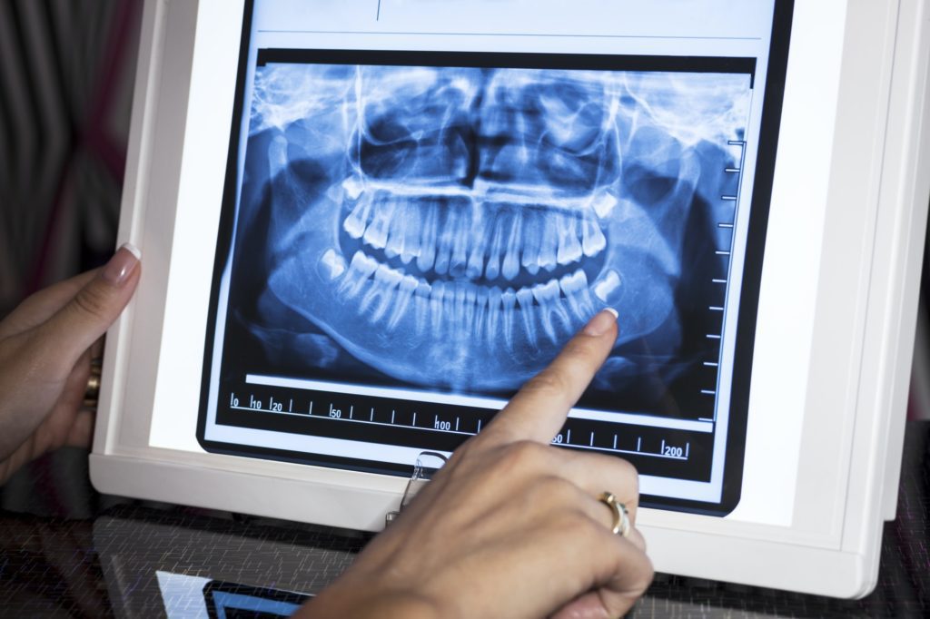 Radiografías Dentales Dental X-Rays - Radiografías Dentales