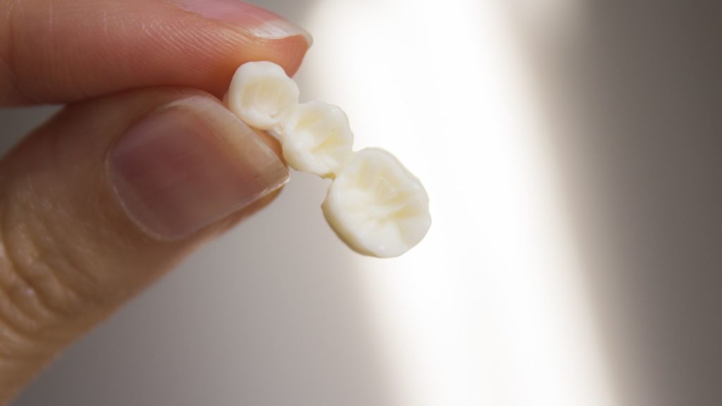 dental bridge dental bridge