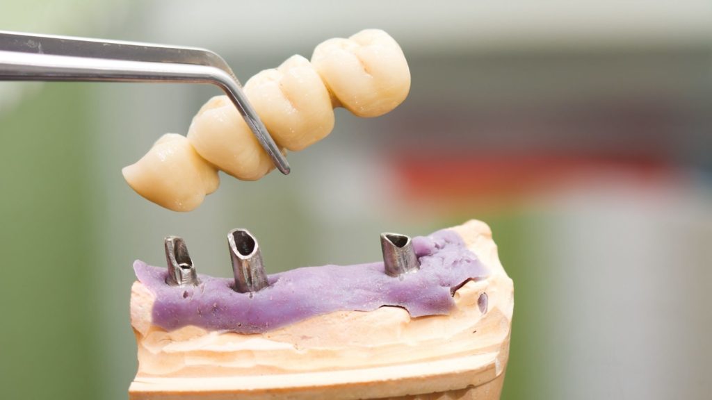 dental bridge dental bridge