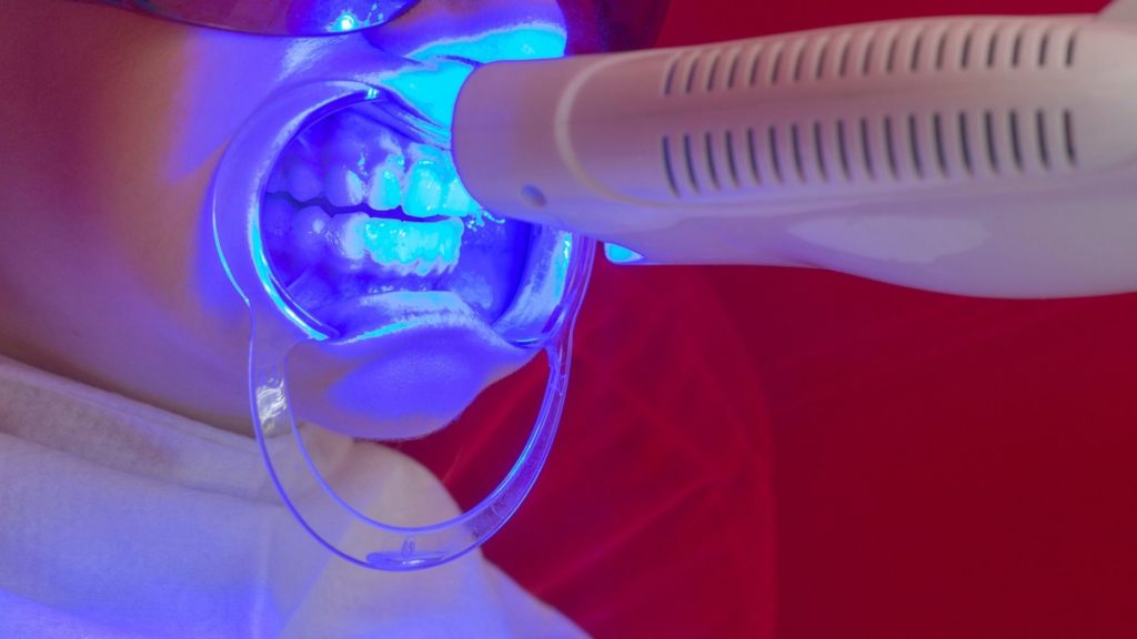 laser teeth whitening with zoom laser teeth whitening with zoom